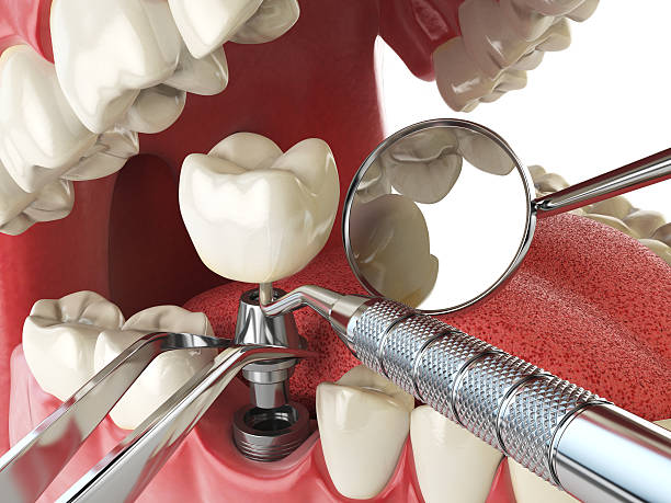 Best Emergency Dental Care for Broken or Chipped Teeth in Bnchard, LA